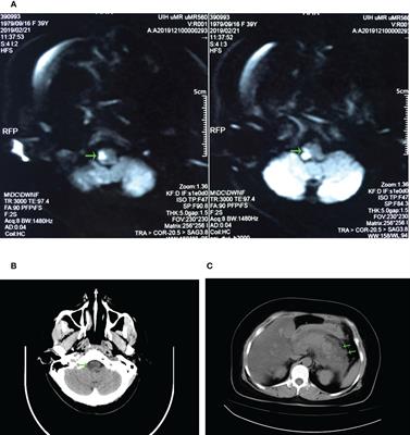 Hypertriglyceridemia may contribute to stroke and pancreatitis: A case report and review of the literature